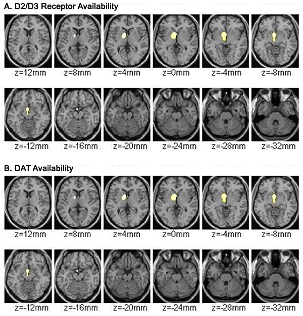 brain scans